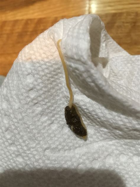 Stringy stuff in stool