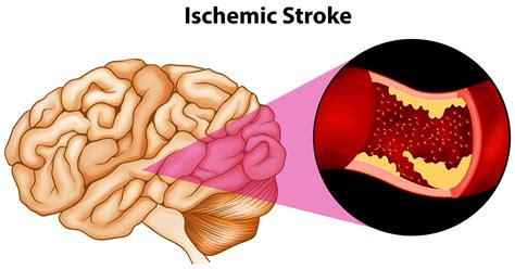 Stroke image. Magnetic resonance imaging (MRI) is increasingly being used in the diagnosis and management of acute ischemic stroke and is sensitive and relatively specific in detecting changes that occur after such strokes. Advances in MRI include higher strength of magnetic field (1. 