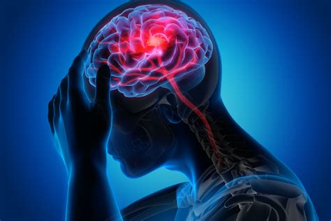 Stroke pictures. severe headache without an apparent cause. Additionally, less commonly recognized symptoms of a stroke include: sudden loss of one or more senses (seeing, hearing, smelling, tasting, or touching ... 