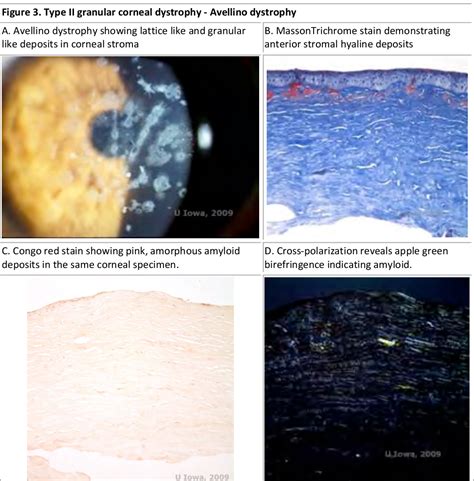 Stromal Dystrophies SpringerLink