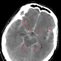 Subarachnoid hemorrhage in the emergency department