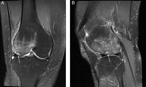 Subchondral insufficiency fracture of the knee