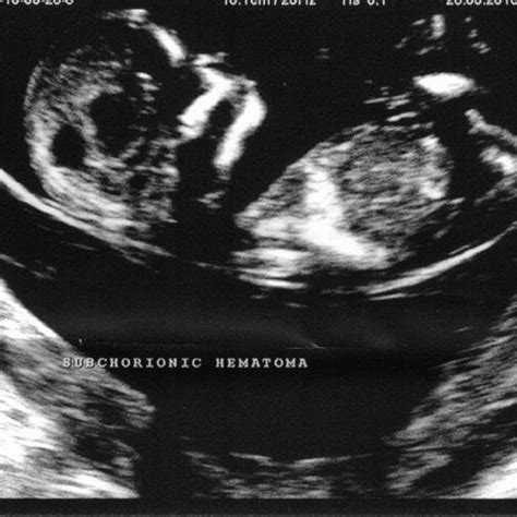 Subchorionic Haematoma - Somerset Early Scans