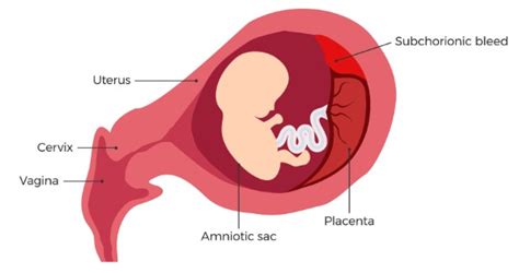 Subchorionic bleed in first trimester
