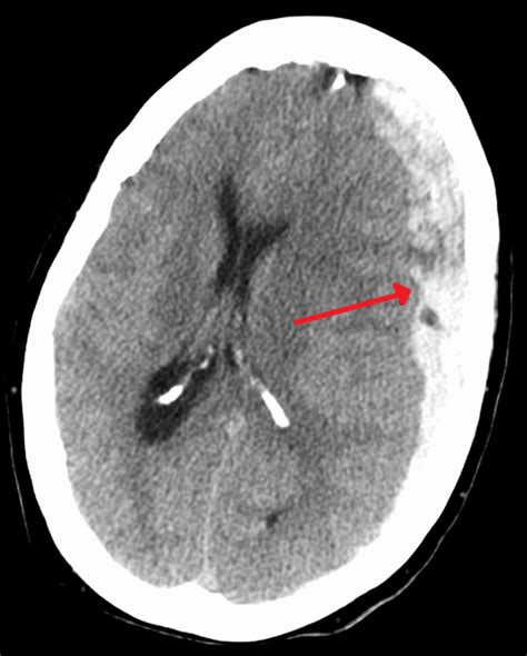 Subduraal hematoom - Wikipedia