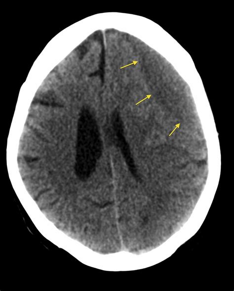 Subdural haematoma Subdural Haemorrhage