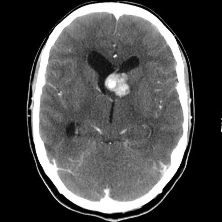 Subependymal giant cell astrocytoma Radiology Reference …