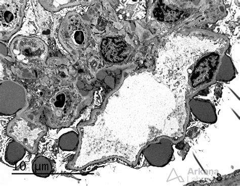 Subepithelial Humps Teaching Points Arkana Laboratories