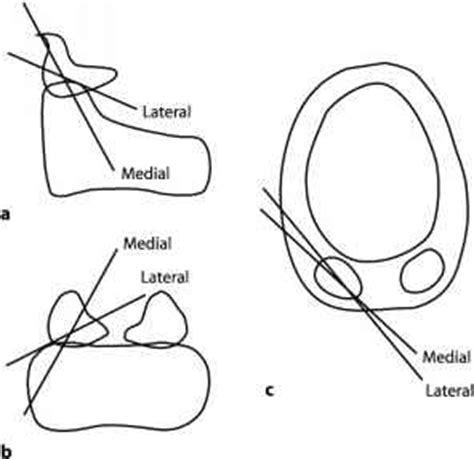 Success Rate Of Gore Tex Thyroplasty - Global Healthcare