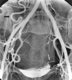 Successful Embolization of Collaterals from the Ovarian Artery …