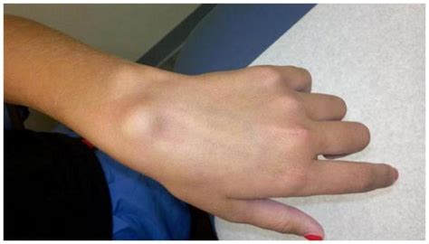 Sudden Swollen Vein In Wrist- 181 Questions Answered - Practo