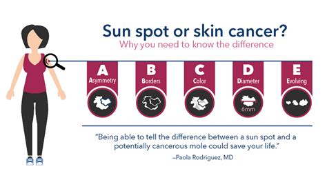 Sun spot or skin cancer? Know the difference - Thrive