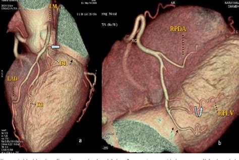 Superdominant Left Circumflex Artery with Absent Right Coronary …