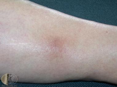 Superficial Thrombophlebitis Clinical Presentation: History, …