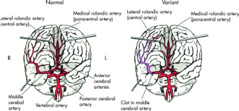 Superficial middle cerebral artery territory infarction - PubMed