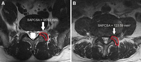 Superior articular process cross-sectional area is a new sensitive ...