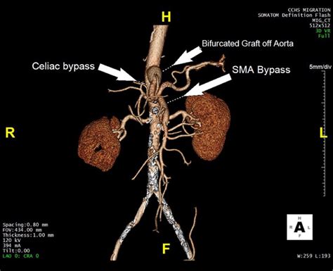 The superior mesenteric artery (SMA) provides vital blood supply to the midgut, and an acute abnormality can rapidly precipitate bowel ischemia and infarction and lead to morbidity and mortality. Vascular diseases that acutely compromise the SMA threaten its tributaries and include occlusion, dissection, aneurysm rupture, pseudoaneurysm, vasculitis, and SMA branch hemorrhage into the bowel .... 