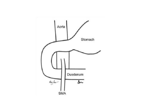 Decreased intraabdominal fat can lead to intraabdominal compressive syndromes, such as superior mesenteric artery (SMA) syndrome. This phenomenon is rare but should be considered in a patient with recent rapid weight loss and acute gastrointestinal complaints. A delay in diagnosis and treatment can lead to severe complications, such as a ...