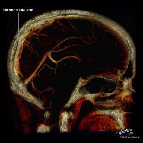 Superior sagittal sinus Radiology Reference Article Radiopaedia.org