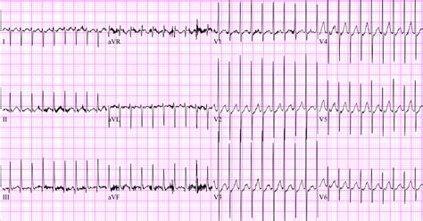 Supraventricular Tachycardia in a Term Neonate Pediatrics In …