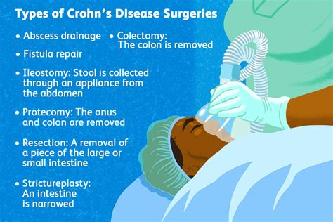 Surgery for Crohn’s Disease: Types of Surgery