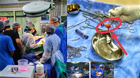 Surgery ke baad.  Tested.  Test karo.  Temporary.  Weight loss ke baad baal girna die...