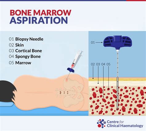 Surgical Approach of the Anatomical Sites for Bone Marrow Aspiration …