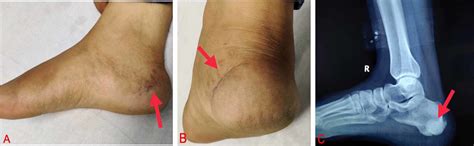 Surgical Removal of Giant Cell Tumors - Alliance Foot