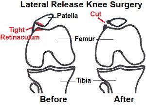 Surgical Technique: Lateral Retinaculum Release in Knee Arth ... - LWW