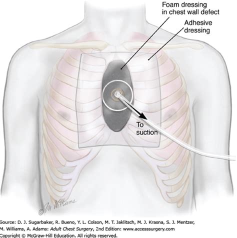 Surgical Treatment of Chest Wall Infections Adult Chest Surgery, 2e A…