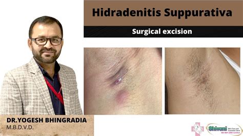 Surgical treatment of hidradenitis suppurativa: experiences …