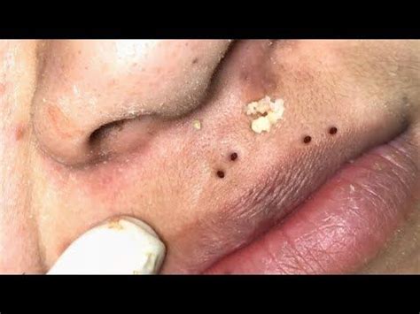 4. Belly Button Jam. You don't see this every day. 5. Back of the Neck Blackheads. Ribbons on ribbons on ribbons. Related: Best Pimple-Popping Videos. 6. Inner Ear Blackhead.. 