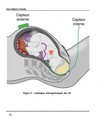 Surveillance foetale guide de lenregistrement cardiotocographique des autres moyens de surveillance du foetus. - Borg warner velvet drive repair manual.