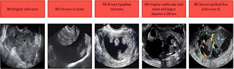 Suspected Ovarian Cancer... hemorrhagic cyst Cancer Chat