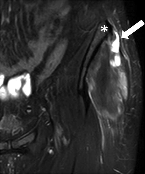 Suture Anchor Repair of a Combined Tear of the Proximal Iliotibial Band …