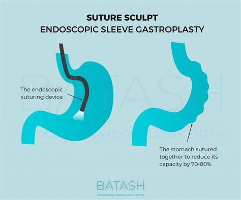 Suture Sculpt Endoscopic Sleeve Price