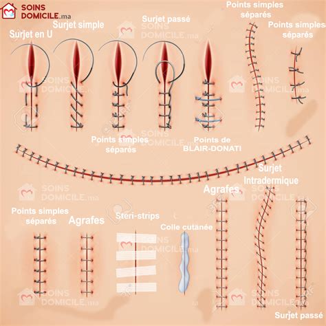 Suture chirurgicale : Types, points de suture, plus