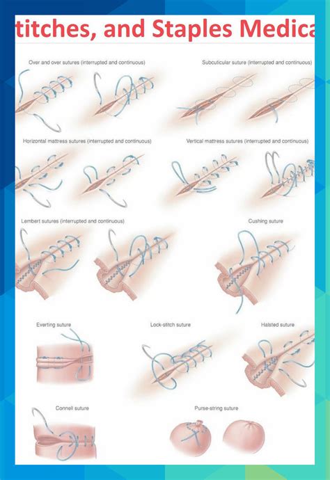 Read Online Suture Like A Surgeon A Doctors Guide To Surgical Knots And Suturing Techniques Used In The Departments Of Surgery Emergency Medicine And Family Medicine By M Mastenbjrk Md