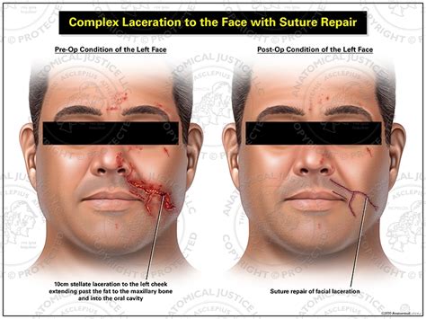 th?q=Suturing facial lacerations emedicine
