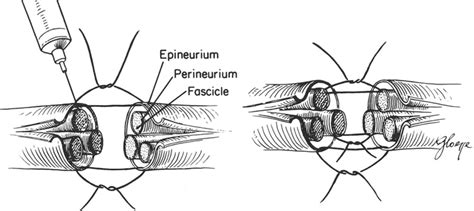 A nerve graft could be used to restore the injured nerve, but a clean, sharp nerve injury such as a cut with a sharp object can sometimes be repaired by re-connecting the ends of the nerve. The length of the gap. A nerve graft’s success largely depends on the length of the graft. Shorter grafts tend to provide better results than longer grafts.. 