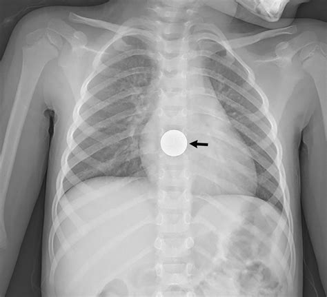 Swallowed foreign body icd-10. The 2024 edition of ICD-10-CM T18.3 became effective on October 1, 2023. This is the American ICD-10-CM version of T18.3 - other international versions of ICD-10 T18.3 may differ. Reimbursement claims with a date of service on or after October 1, 2015 require the use of ICD-10-CM codes. ICD 10 code for Foreign body in small intestine. 