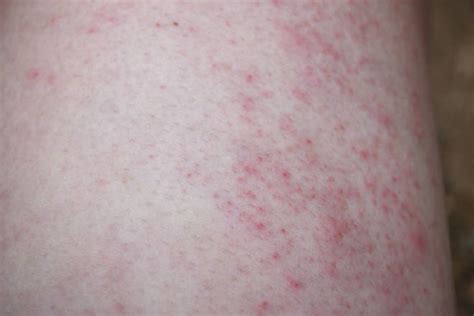 Sweat rash in adults