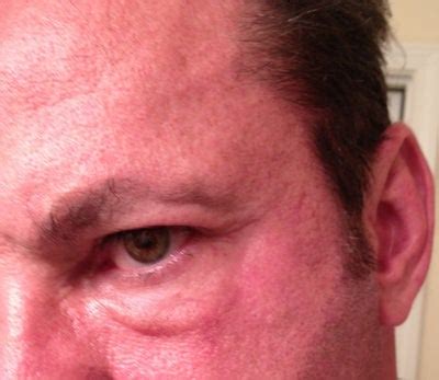 Swelling on cheek under eye HealthTap Online Doctor