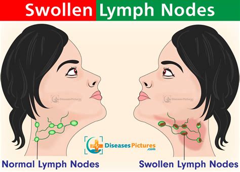 Swollen Lymph Nodes, Glands – Lymphedema, Lymphadenopathy