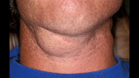 Swollen lymph node on neck and ear after laser root canal?