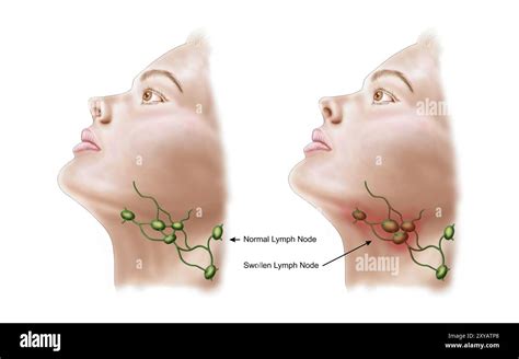 Swollen lymph nodes