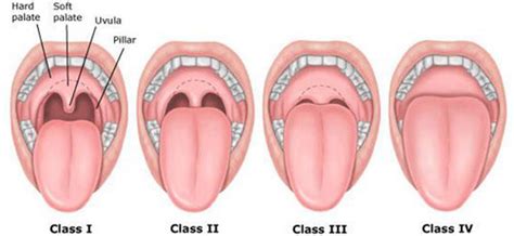 Swollen uvula after surgery. Things To Know About Swollen uvula after surgery. 
