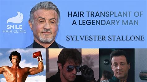 Sylvester Stallone’s Hair Transplantation - Smile Hair Clinic