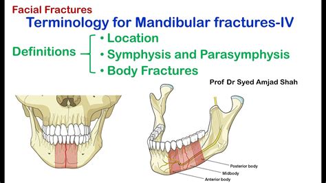 Symphysis and parasymphysis fractures - PubMed