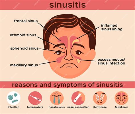 Symptomen sinusitis